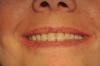 protesi Full Arch e L’Implantologia dentaria a carico immediato